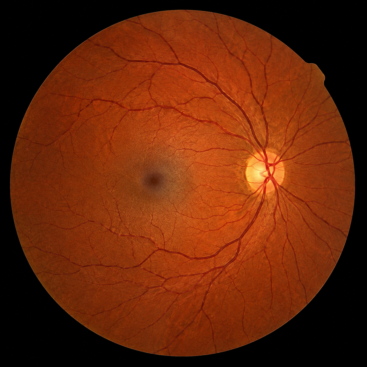 Phacoemulsification Machine for Cataract